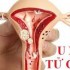 U xơ tử cung là gì? Nguyên nhân, triệu chứng