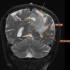 PHÁT HIỆN SỚM U NÃO NHỜ CÔNG NGHỆ CHỤP MRI