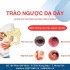 TRÀO NGƯỢC DẠ DÀY: ĐỪNG COI THƯỜNG NHỮNG CƠN Ợ NÓNG!